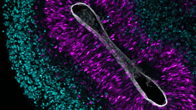 A microscopy picture of an 8-week-old human cortical organoid. Neurons are labeled in cyan and neural stem cells are labeled in magenta. The grey color shows the lining of one of the brain’s internal cavities.
